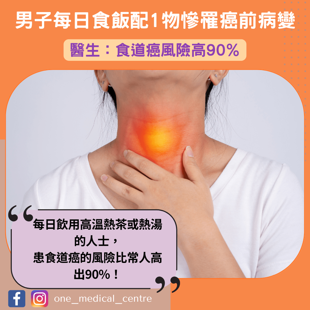 【男子每日食飯配1物慘罹癌前病變　醫生：食道癌風險高90％】